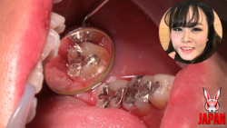 Dental Treatment ; Amateur Girl MEGUMI (25)  (2nd Time)